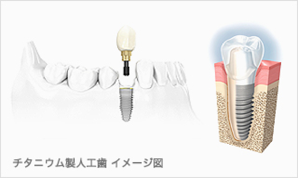チタニウム製人工歯のイメージ図です